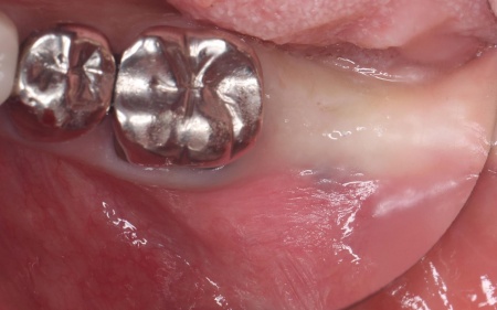 治療前 | 市ヶ谷・歯医者