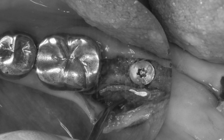 治療中 | 市ヶ谷・歯医者