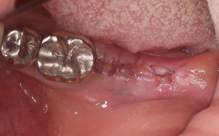 治療中 | 市ヶ谷・歯医者