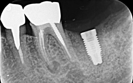 治療中 | 市ヶ谷・歯医者