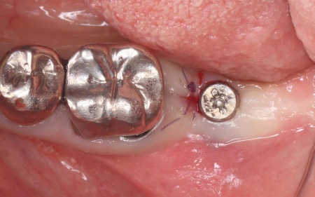 治療中 | 市ヶ谷・歯医者