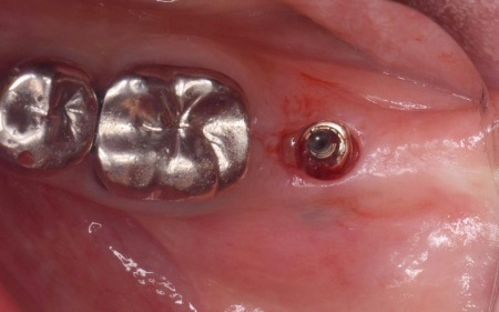 治療中 | 市ヶ谷・歯医者