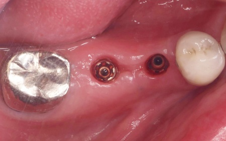 治療後 | 市ヶ谷・歯医者