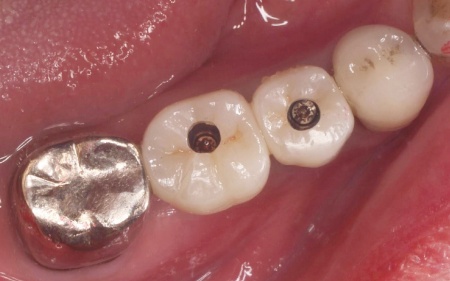 治療後 | 市ヶ谷・歯医者