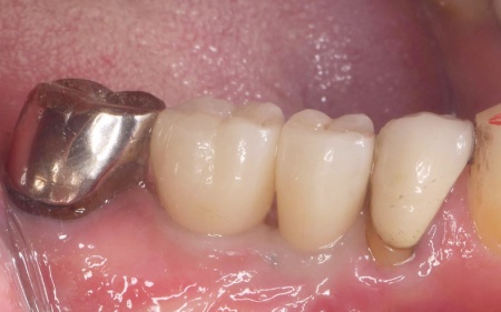 治療後 | 市ヶ谷・歯医者