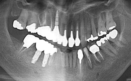 治療後 | 市ヶ谷・歯医者