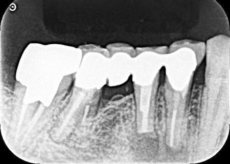 治療前 | 市ヶ谷・歯医者