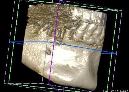 治療前 | 市ヶ谷・歯医者