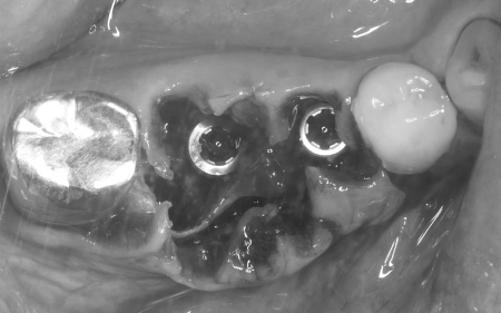 治療中 | 市ヶ谷・歯医者