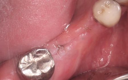 治療中 | 市ヶ谷・歯医者