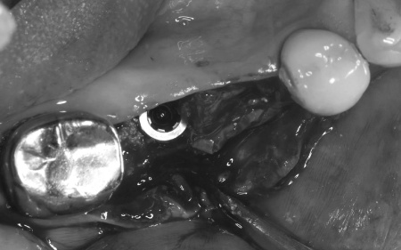 治療中 | 市ヶ谷・歯医者