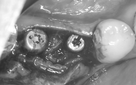 治療中 | 市ヶ谷・歯医者