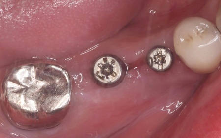 治療中 | 市ヶ谷・歯医者