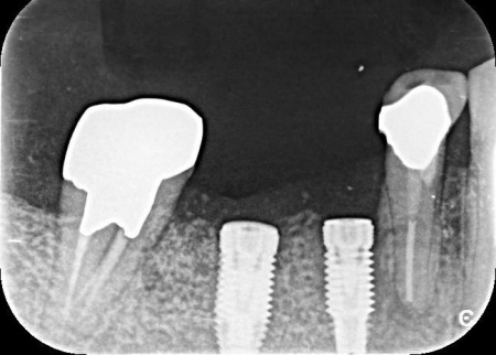 治療中 | 市ヶ谷・歯医者