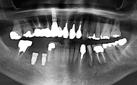 治療中 | 市ヶ谷・歯医者