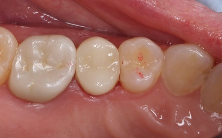 治療後 | 市ヶ谷・歯医者