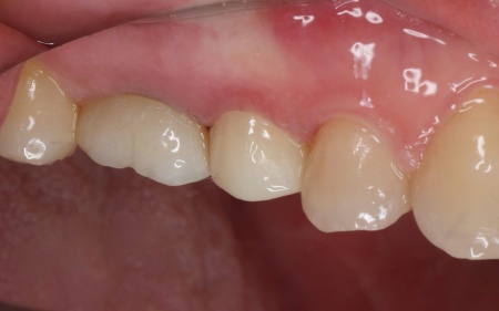 治療後 | 市ヶ谷・歯医者