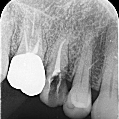 治療中 | 市ヶ谷・歯医者