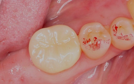 治療後 | 市ヶ谷・歯医者