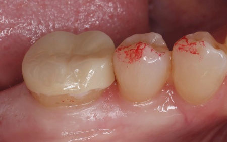 治療後 | 市ヶ谷・歯医者