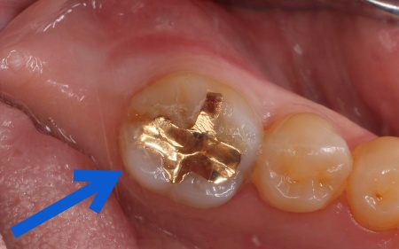 治療前 | 市ヶ谷・歯医者