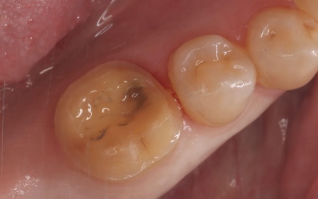 治療中 | 市ヶ谷・歯医者