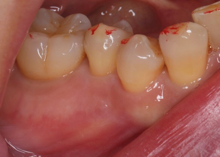 治療後 | 市ヶ谷・歯医者