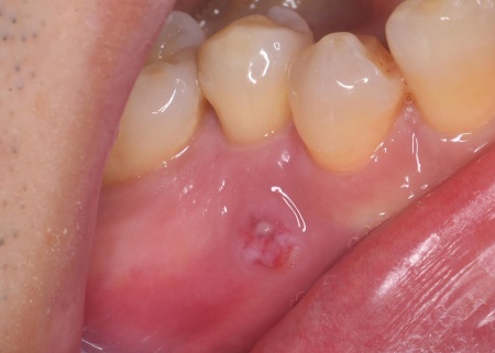 治療前 | 市ヶ谷・歯医者