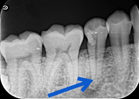 治療前 | 市ヶ谷・歯医者
