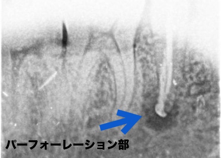 治療中 | 市ヶ谷・歯医者