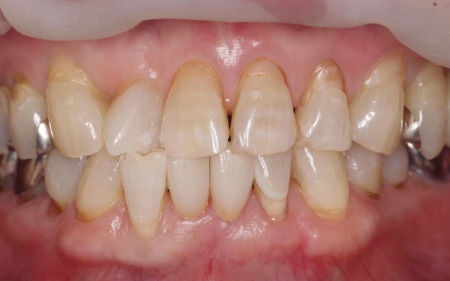 治療後 | 市ヶ谷・歯医者