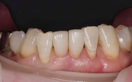 治療後 | 市ヶ谷・歯医者