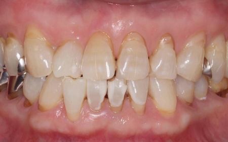 治療前 | 市ヶ谷・歯医者