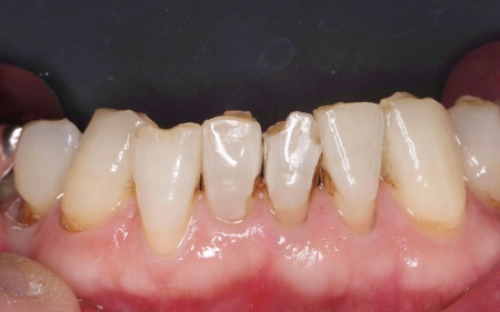 治療前 | 市ヶ谷・歯医者