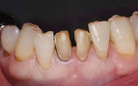 治療中 | 市ヶ谷・歯医者