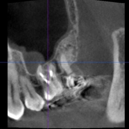 治療後 | 市ヶ谷・歯医者