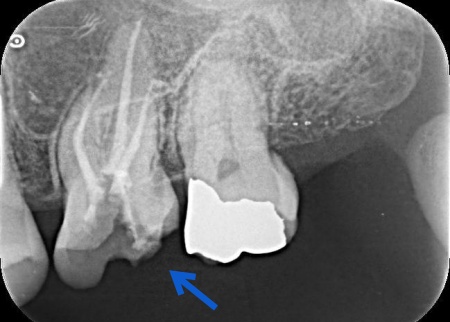 治療中 | 市ヶ谷・歯医者