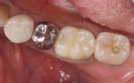 治療後 | 市ヶ谷・歯医者