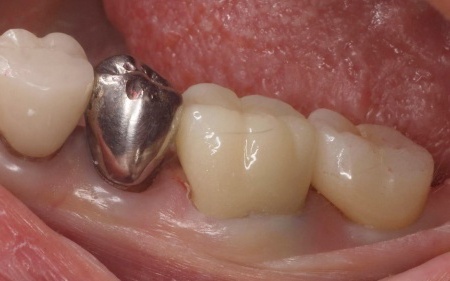 治療後 | 市ヶ谷・歯医者