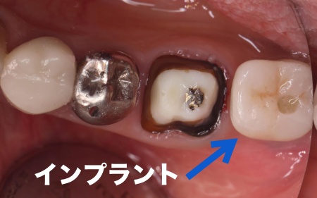 治療中 | 市ヶ谷・歯医者