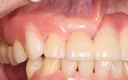 治療後 | 市ヶ谷・歯医者