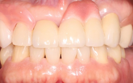 治療後 | 市ヶ谷・歯医者