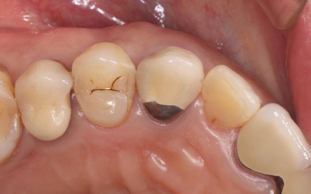 治療前 | 市ヶ谷・歯医者