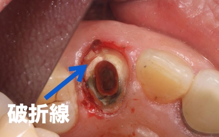 治療前 | 市ヶ谷・歯医者