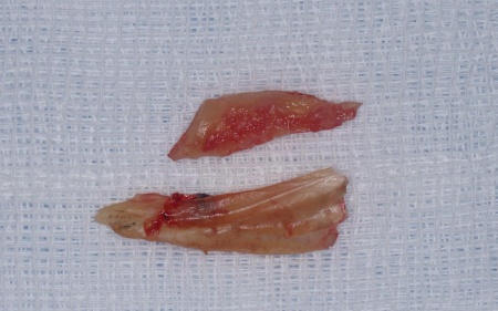 治療前 | 市ヶ谷・歯医者