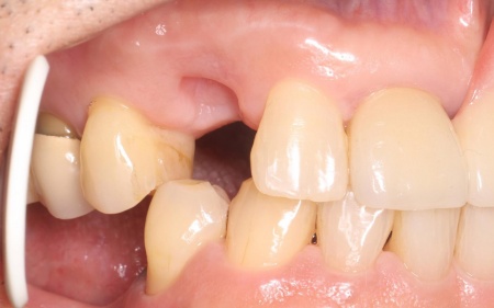 治療中 | 市ヶ谷・歯医者