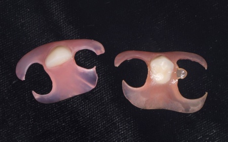 治療中 | 市ヶ谷・歯医者