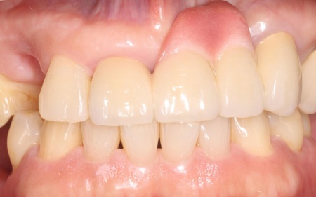 治療中 | 市ヶ谷・歯医者