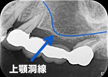 治療前 | 市ヶ谷・歯医者