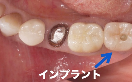 治療中 | 市ヶ谷・歯医者